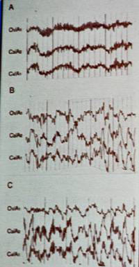 Alpha Intrusions CFS