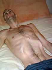 ME/CFS Patient Bald Emaciated with ME/CFS